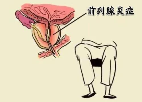 前列腺凝膠OEM廠家