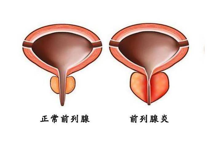 前列腺凝膠貼牌廠家