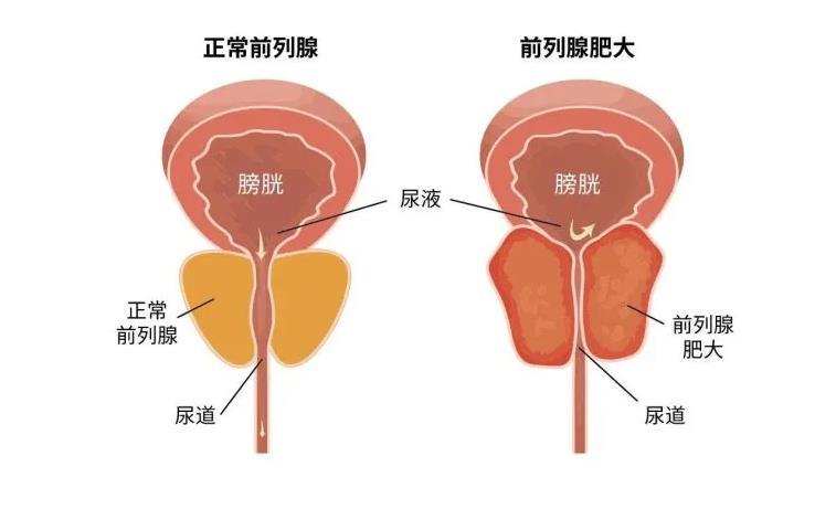 前列腺凝膠oem廠家