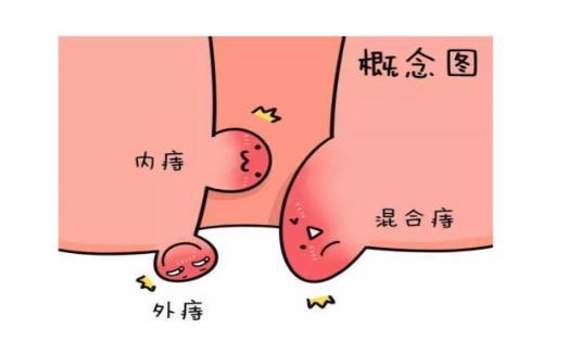 痔瘡凝膠貼牌廠(chǎng)家